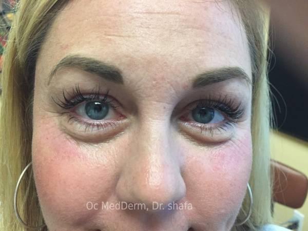 Before Dark Circle Under Eye Correction with Fillers in Irvine, CA