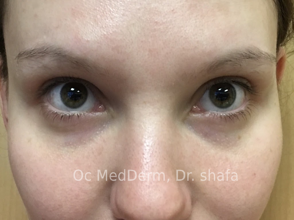 Before Dark Circle Under Eye Correction with Fillers in Orange County