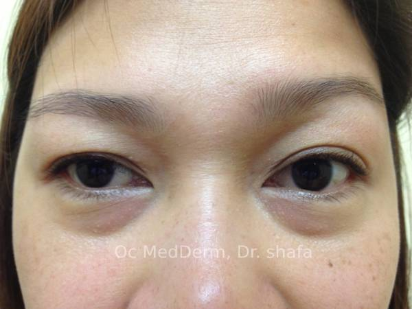 Before Dark Circle Under Eye Correction with Fillers in Orange County