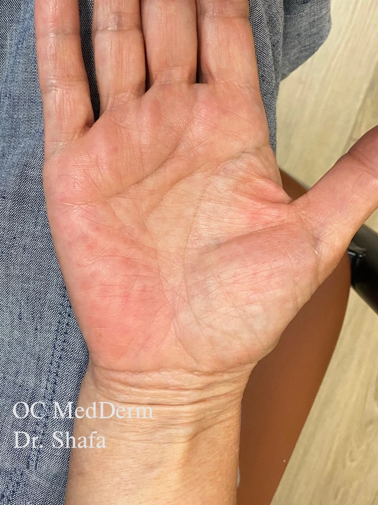 After Eczema Treatment In California At OC MedDerm