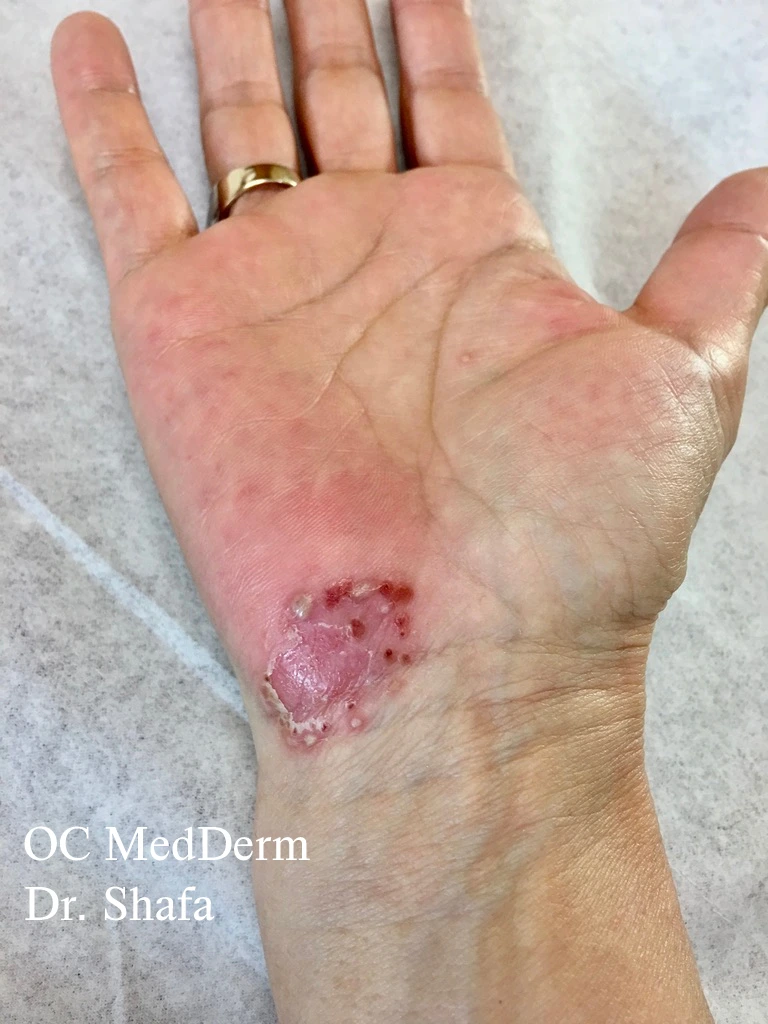 Before Eczema Treatment In California At OC MedDerm
