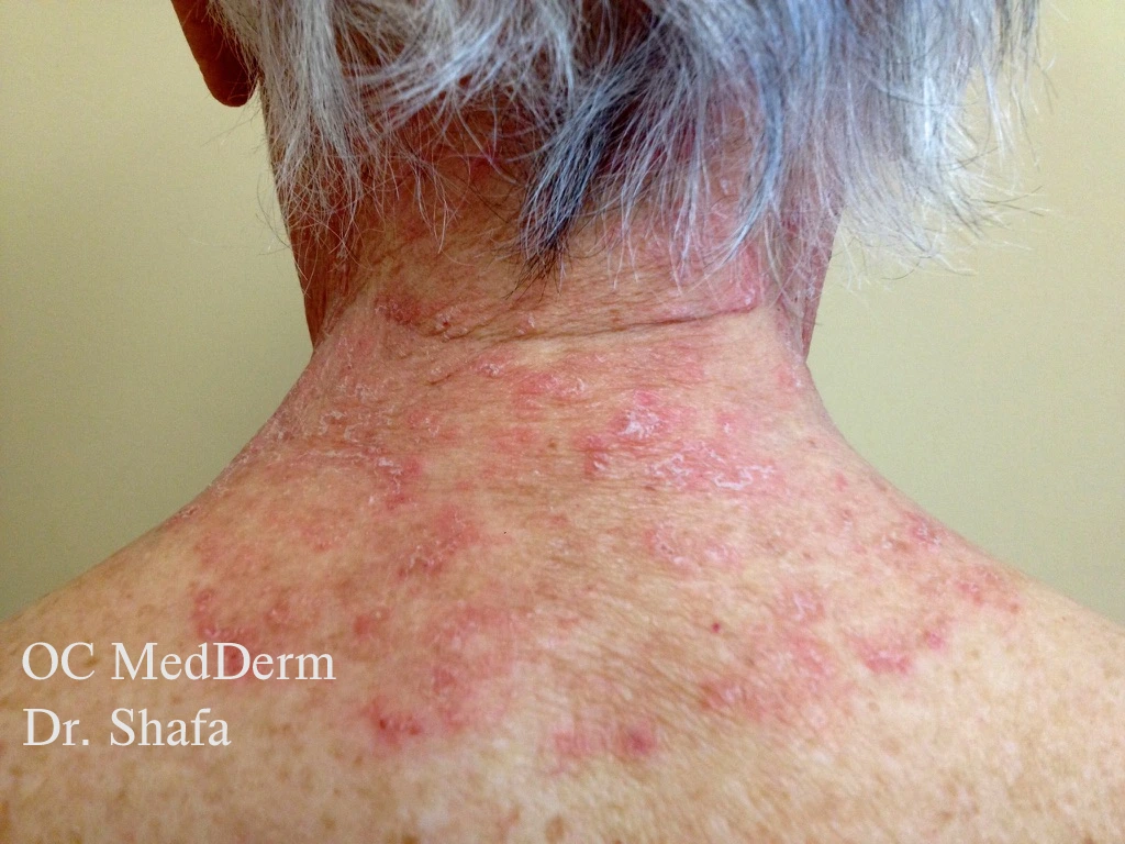 Before Eczema Treatment In Irvine, CA At OC MedDerm