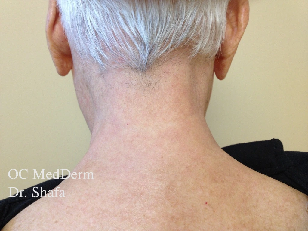 After Eczema Treatment In Irvine, CA At OC MedDerm