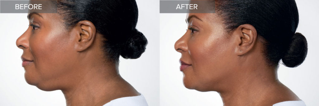 Kybella Double Chin Treatment Before and After Results In Irvine, CA