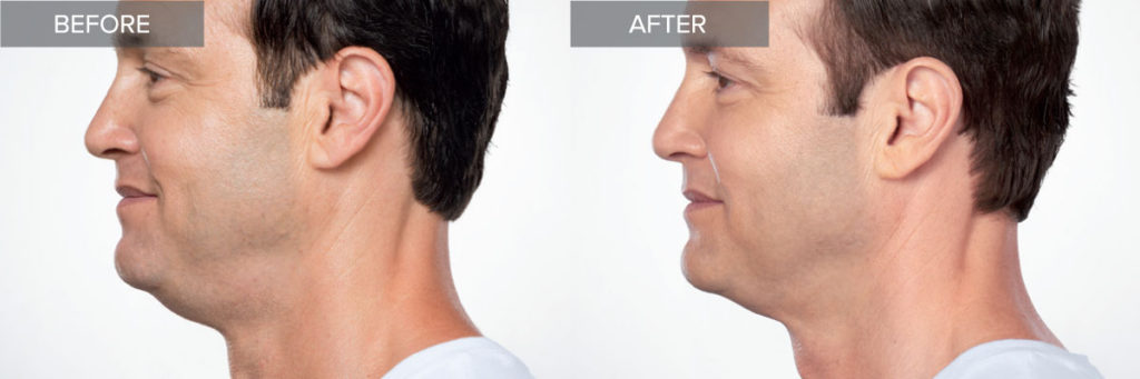 Kybella Double Chin Treatment Before and After Results In Irvine, CA