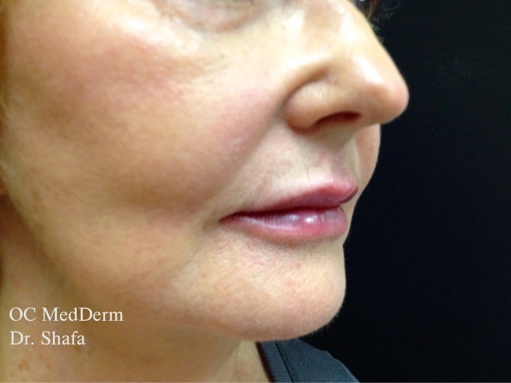 After Lip Asymmetry With Fillers In Irvine, CA At OC MedDerm
