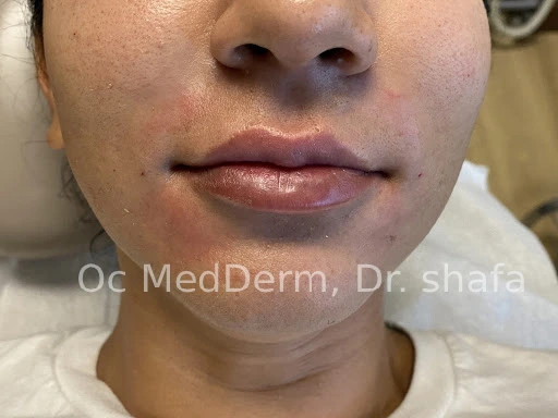 After Lip Asymmetry With Fillers In Irvine, CA At OC MedDerm