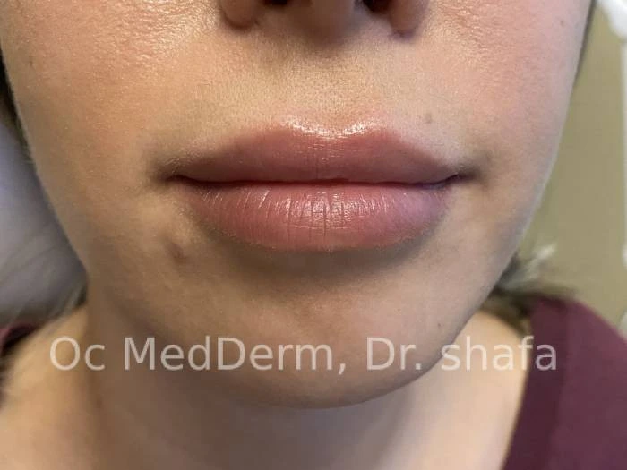 After Lip Asymmetry With Fillers In Irvine, CA At OC MedDerm