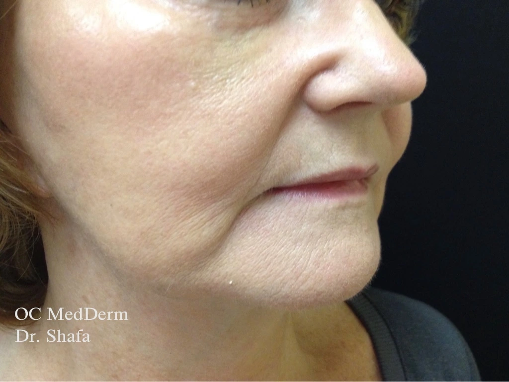 Before Lip Asymmetry With Fillers In Irvine, CA At OC MedDerm