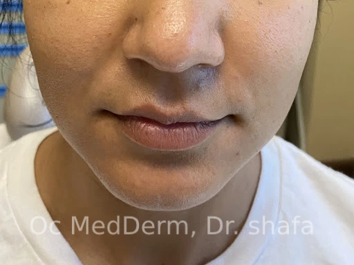 Before Lip Asymmetry With Fillers In Irvine, CA At OC MedDerm