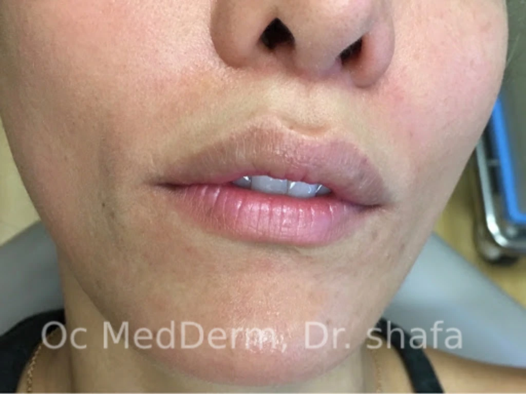 Before Lip Asymmetry With Fillers In Irvine, CA At OC MedDerm