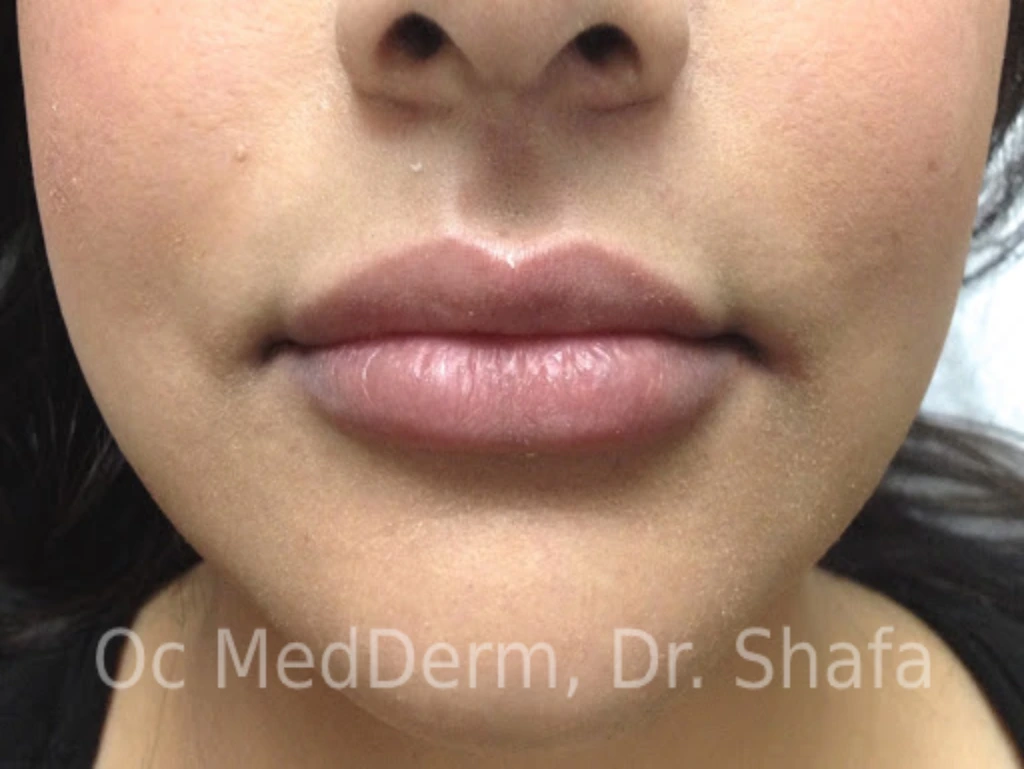 After Lip Augmentation with Fillers In Irvine At OC MedDerm