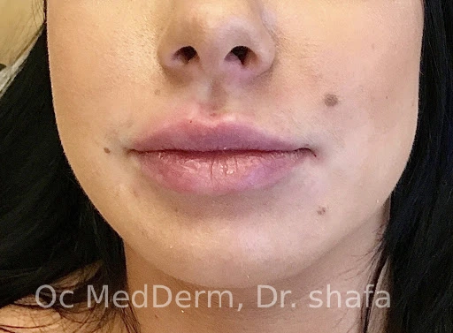 After Lip Asymmetry With Fillers In Irvine, CA At OC MedDerm