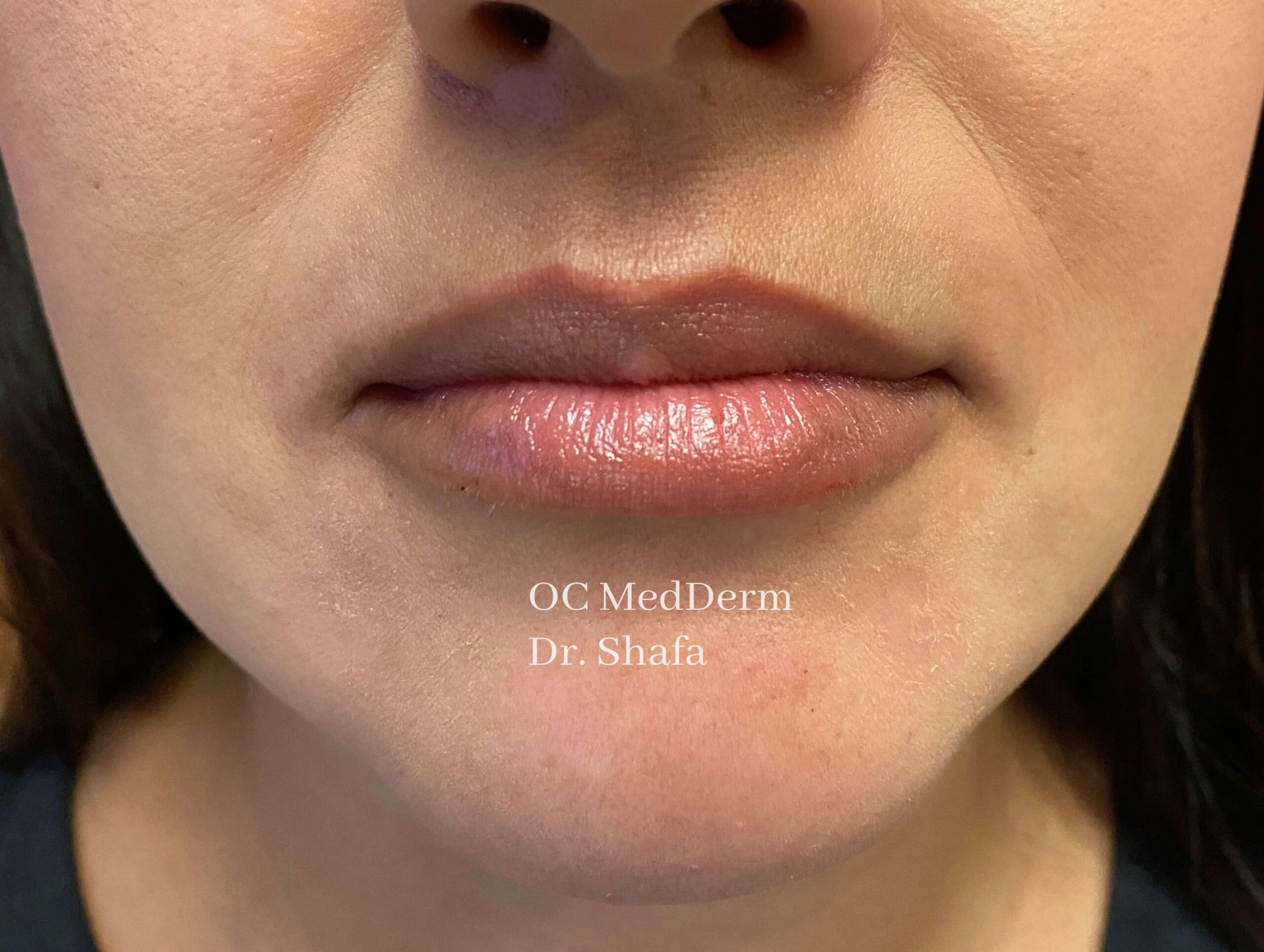 After Lip Asymmetry With Fillers In Irvine, CA At OC MedDerm