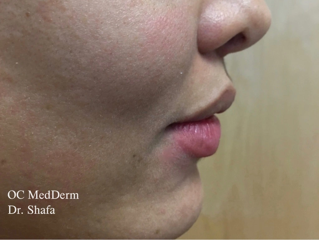 After Lip Asymmetry With Fillers In Orange County At OC MedDerm