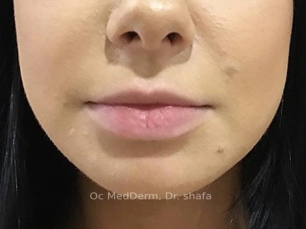 Before Lip Asymmetry With Fillers In Irvine, CA At OC MedDerm