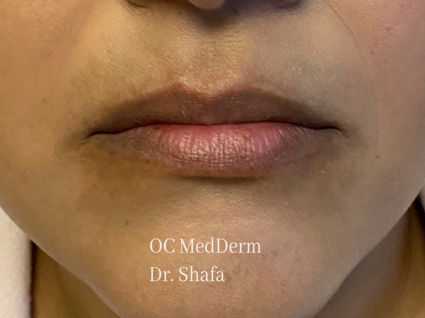 Before Lip Asymmetry With Fillers In Irvine, CA At OC MedDerm