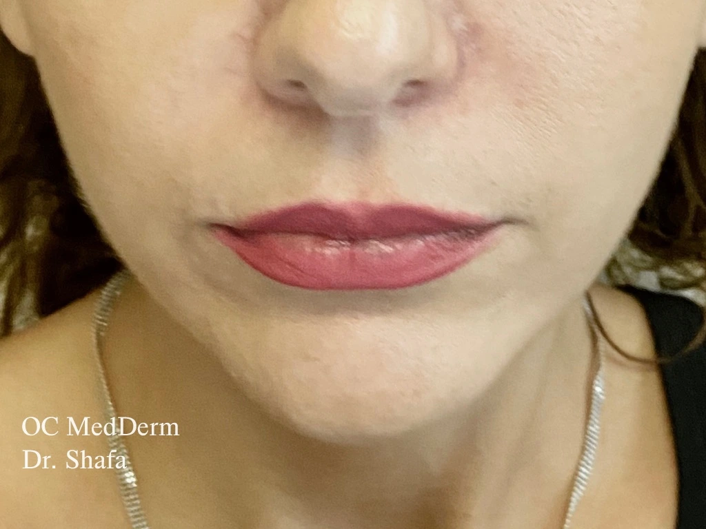 Before Lip Asymmetry With Fillers In Orange County At OC MedDerm