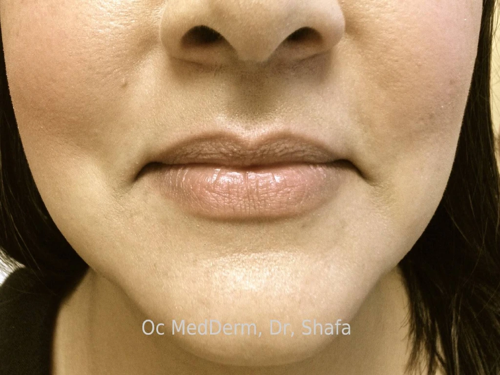 Before Lip Augmentation with Fillers In Irvine At OC MedDerm