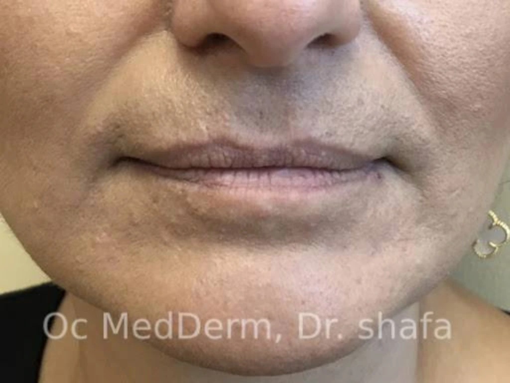 Before Lip Rejuvenation With Fillers In Irvine, CA At OC MedDerm
