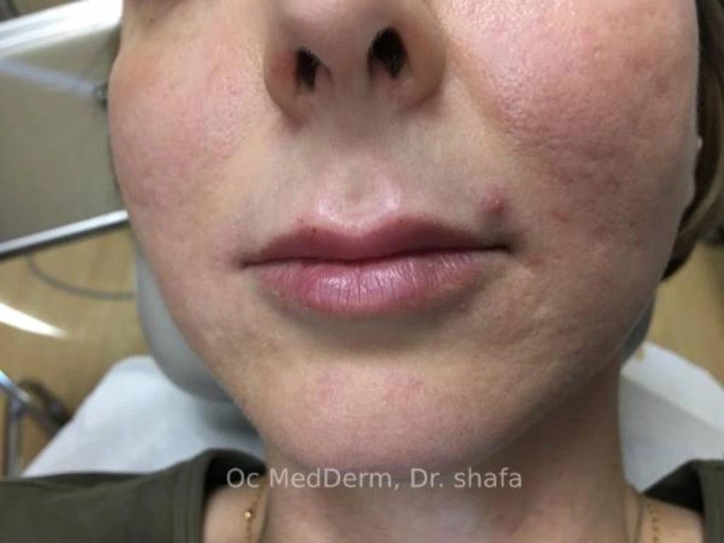 Before Upper Lip Contouring With Fillers In Irvine, CA At OC MedDerm