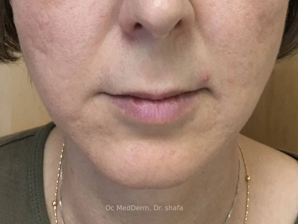 Before Upper Lip Contouring With Fillers In Irvine, CA At OC MedDerm