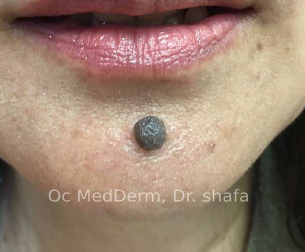 How to Remove Lumps and Bumps?