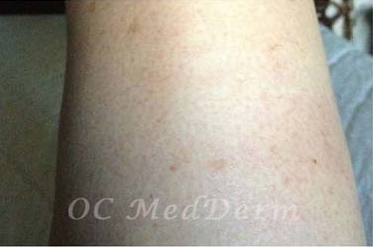 After spider veins removal procedure in Irvine, Orange County