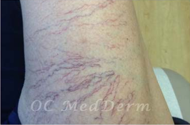 Before spider veins removal procedure in Irvine, Orange County