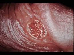 Clinical close-up image of a painless syphilitic chancre (Stage 1 syphilis) on the genital skin, illustrating an early lesion that may heal on its own without treatment, used for patient education by OC MedDerm.