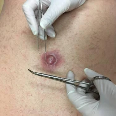 Surgical Dermatology In Irvine, Orange County, CA