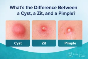 Difference between a cyst, a zit, and a pimple explained by an Irvine dermatologist in Orange County, California