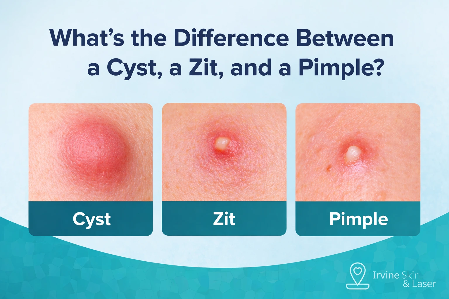 What’s the Difference Between a Cyst, a Zit, and a Pimple?