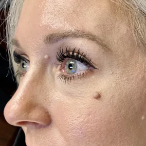 Close-up clinical image of a woman’s face showing small benign skin growths and a raised mole near the eye and cheek area, used for dermatologic evaluation and patient education by OC MedDerm.
