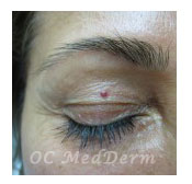 Small benign mole on the upper eyelid evaluated by OC MedDerm dermatologists