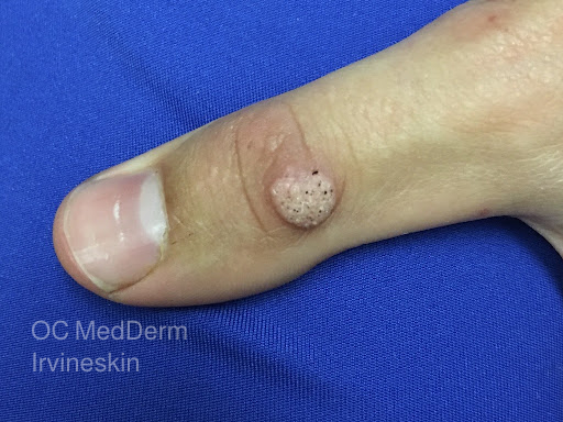 Raised common wart on the finger evaluated by OC MedDerm dermatologists