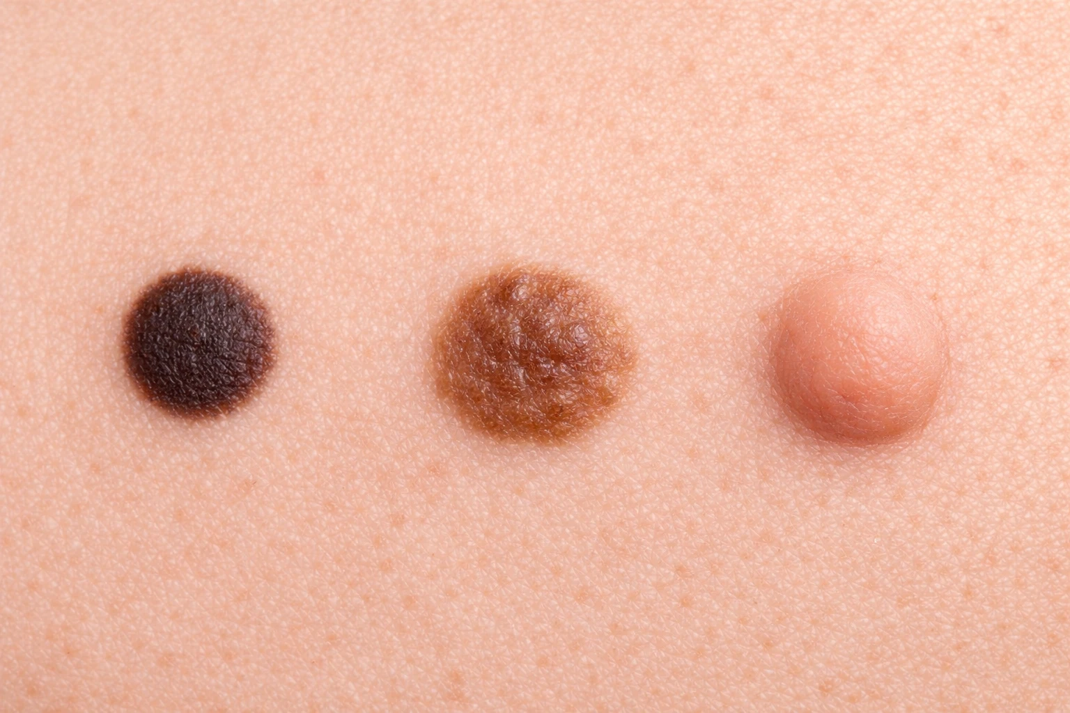 Types of Moles: Understanding Junctional, Compound & Intradermal Nevi