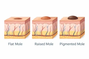 Medical illustration showing different types of skin moles including flat mole raised mole and pigmented mole