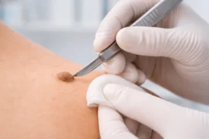Dermatologist performing precise mole removal treatment with minimal scarring in dermatology clinic