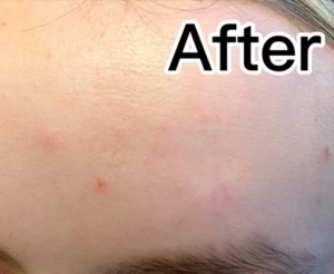 Cyst Scar After Treatment In Irvine, CA at OC MedDerm