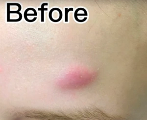 Cyst Scar Before Treatment In Irvine, CA at OC MedDerm