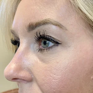 After image showing successful facial mole removal near the eye at OC MedDerm in Irvine, California