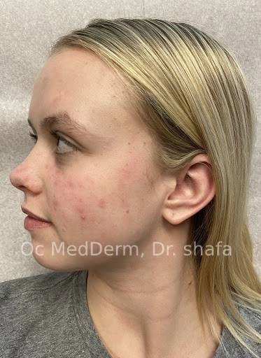 After Shingles Treatment at OC MedDerm Irvine