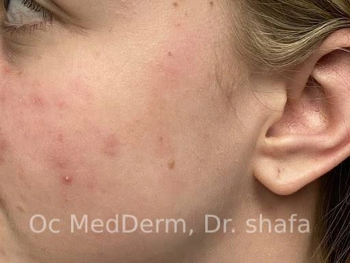 After Shingles Treatment at OC MedDerm