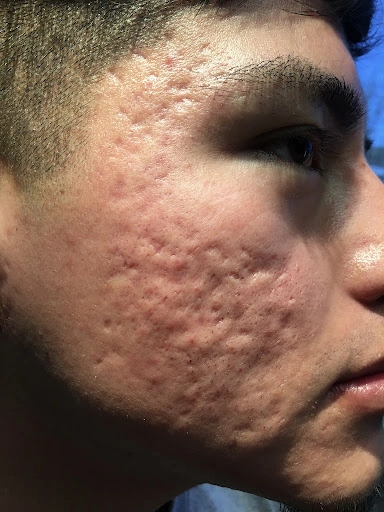Atrophic acne scars Before Treatment Picture at OC MedDerm In Irvine, CA