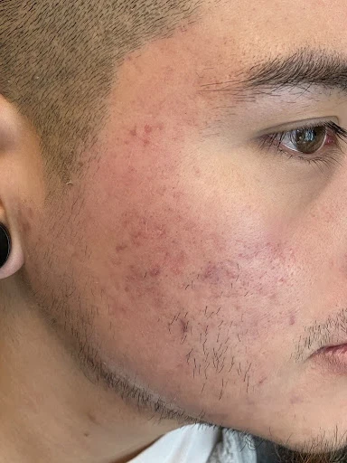 Atrophic acne scars After Treatment Picture at OC MedDerm In Irvine, CA
