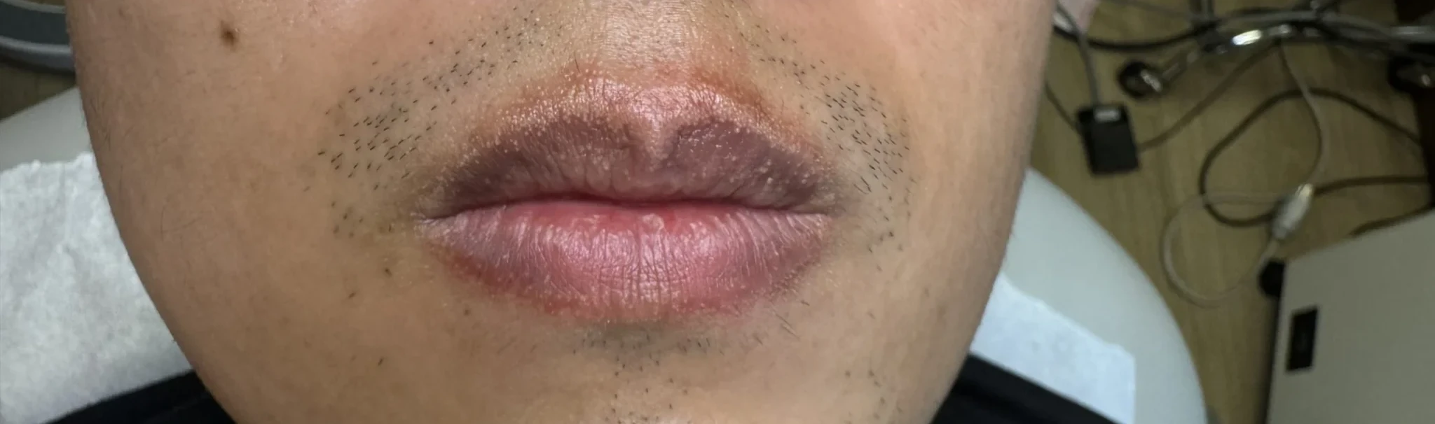 Before Fordyce Spots Treatment at OC MedDerm in Irvine & Orange County, CA