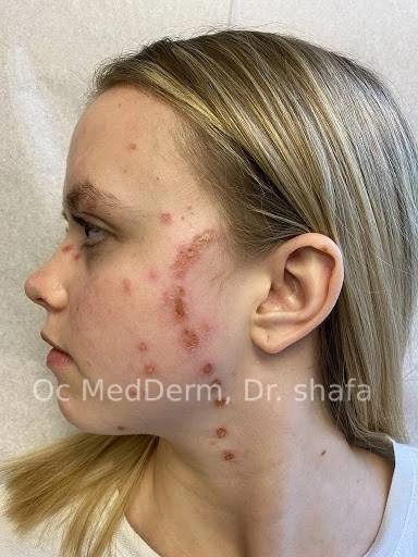 Before Shingles Treatment at OC MedDerm