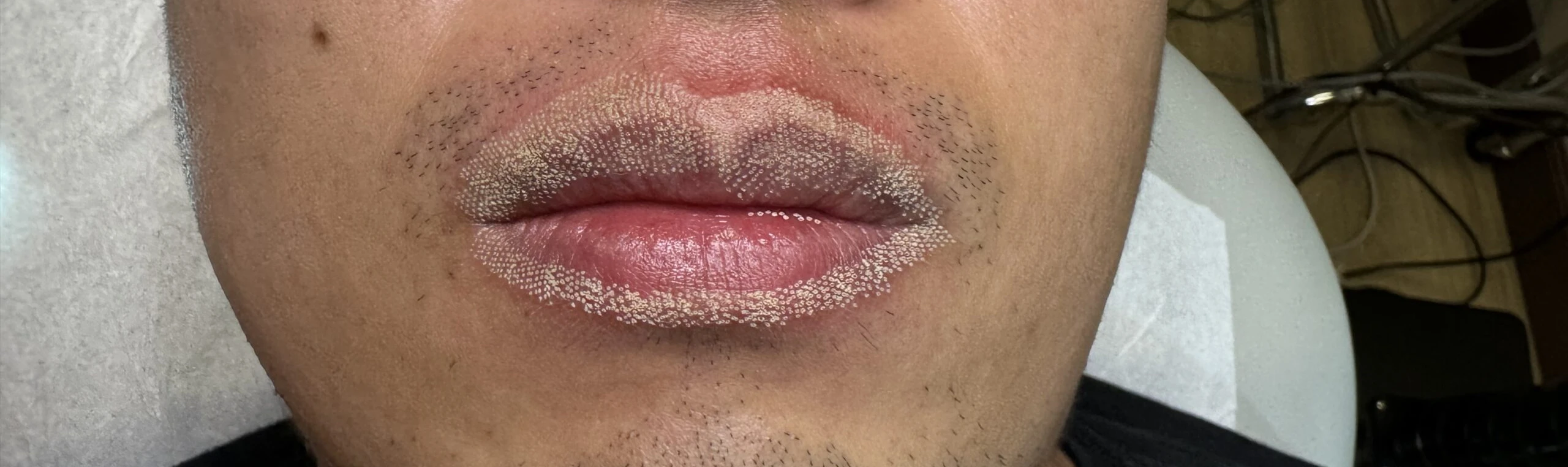 Immediate After Fordyce Spots Treatment at OC MedDerm in Irvine & Orange County CA