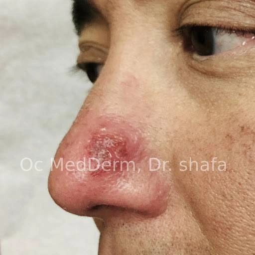 Nose Shingles Infection on men